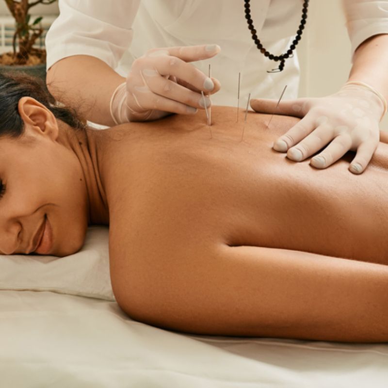 Acupuncture,For,A,Back,Of,A,Young,Woman,In,A